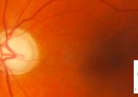 fondo de ojo con glaucoma