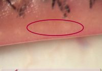 Glándulas de Meibomio